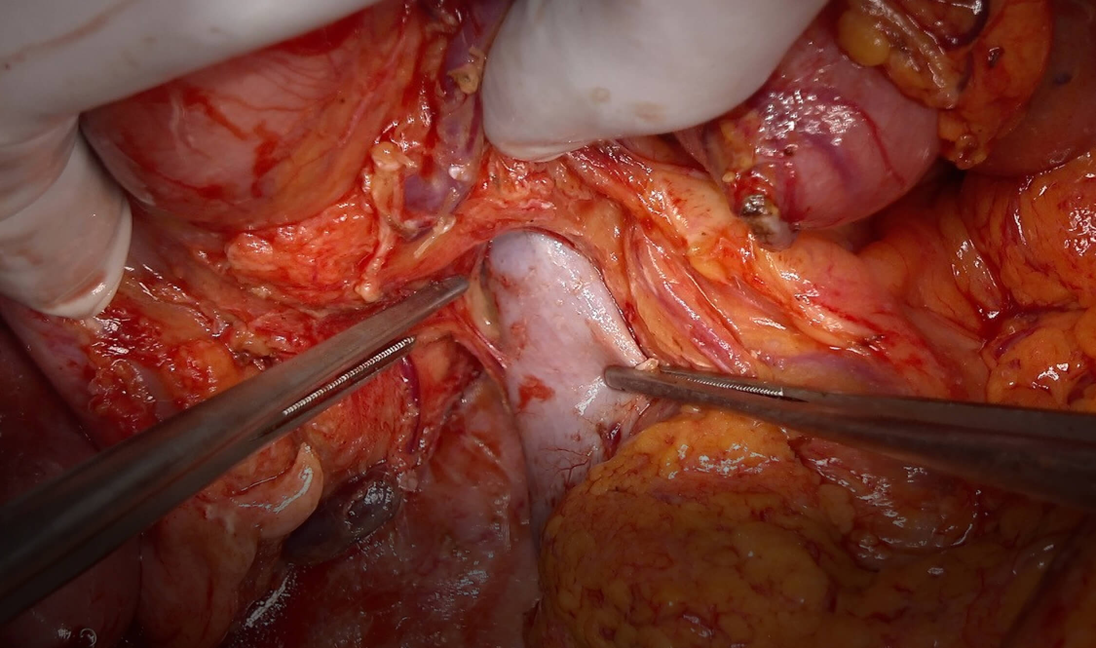 Spot lights　+　4K Camera high quality open surgery videos