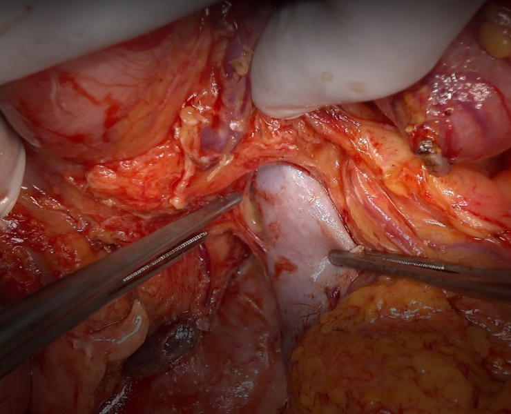 Spot lights　+　4K Camera high quality open surgery videos
